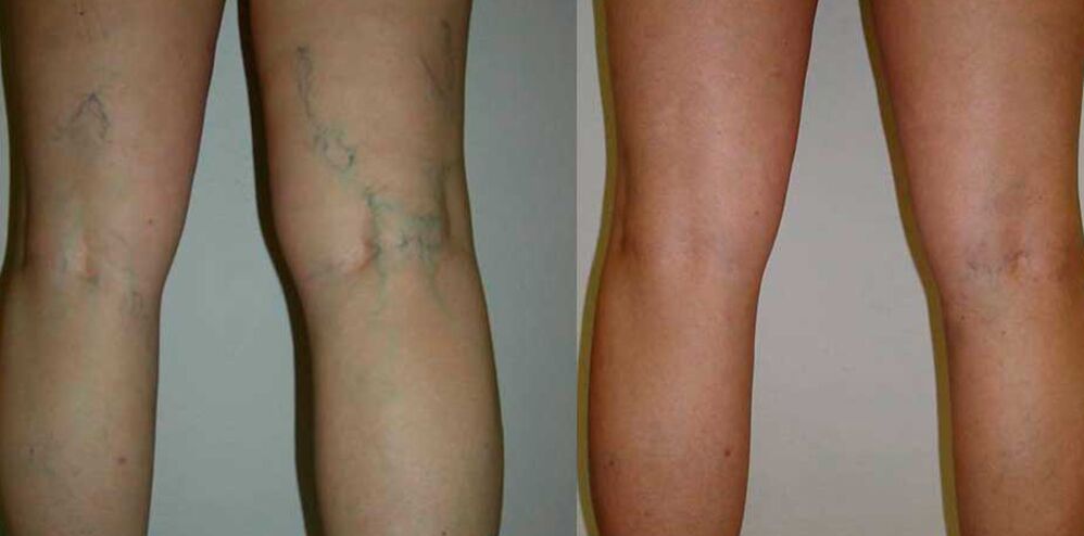 antes e despois do tratamento de varices con Levicose