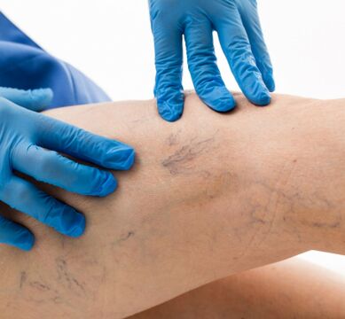 varices