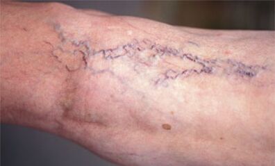 métodos de tratamento de varices nas pernas