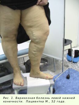 As varices deben ser tratadas para deter o proceso