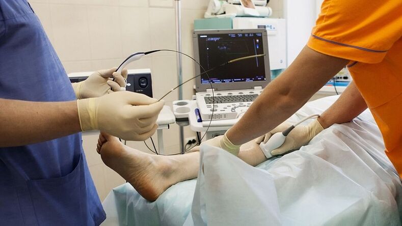 cirurxía para eliminar varices
