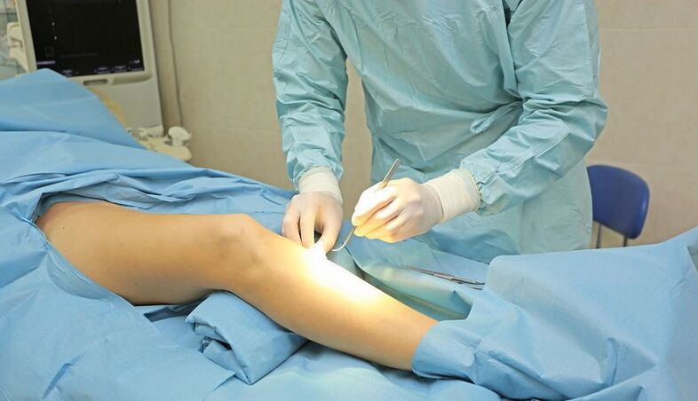 flebectomía para varices