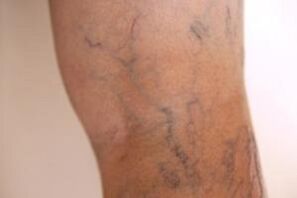 varices nas pernas
