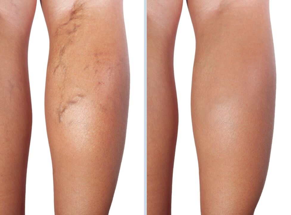 antes e despois do tratamento de varices